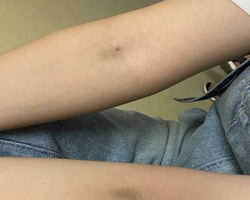 上海哪里代生儿子,子宫内膜异位症吃什么好呢？上海明珠医院